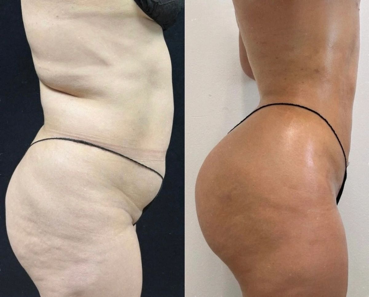 Before and after photos showing Lipo 360 with waist contouring and Brazilian butt lift (BBL) results.