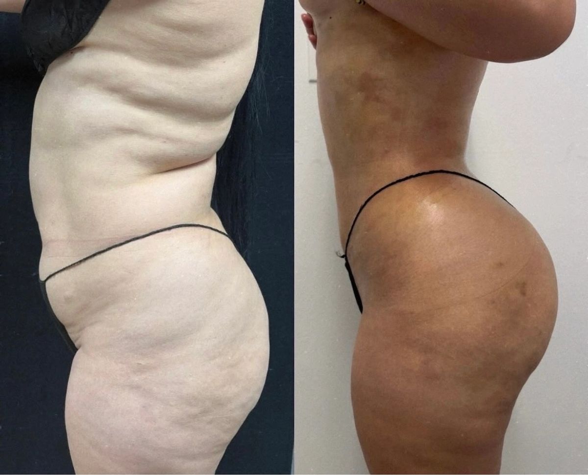 Side-by-side before and after photos showing female body contouring results with flat stomach, slim waist, brazillian butt lift enhancement.