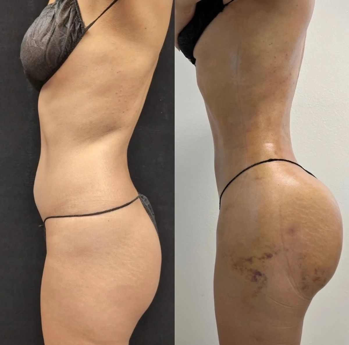 Side-by-side before and after photos showing waist contouring with brazillian butt lift BBL
