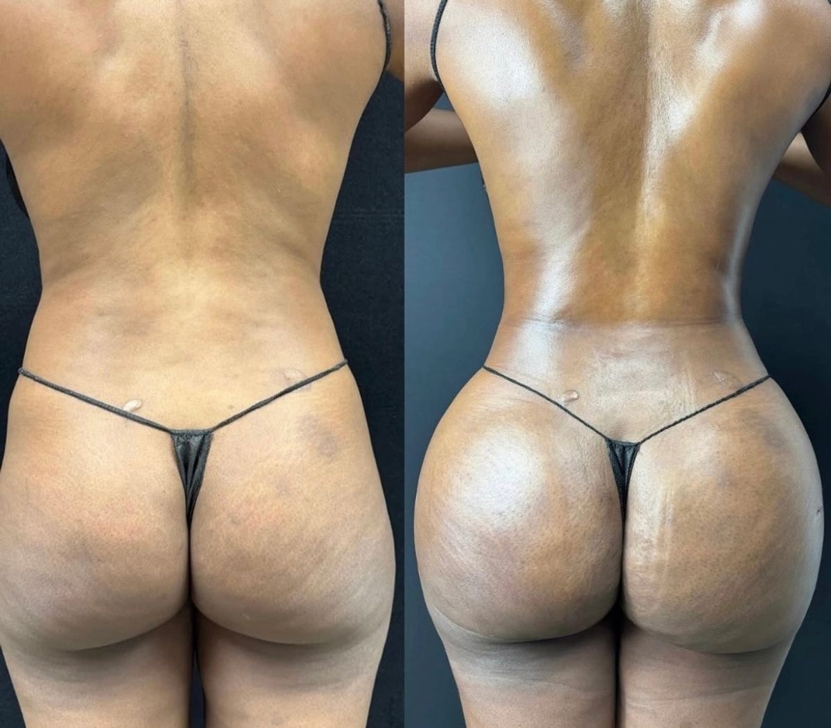 Side-by-side before and after photos showing waist contouring with Brazilian butt lift (BBL) enhancement.