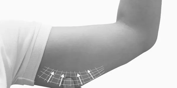 Person pinching upper arm skin representing arm liposuction in Tampa Bay